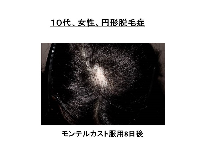円形脱毛症　病院